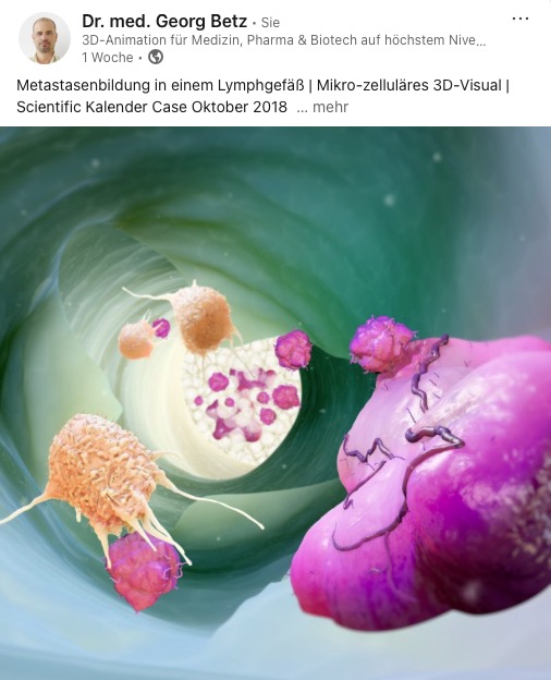 Metastatic growth in a lymph vessel